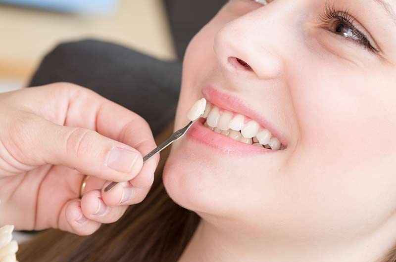 veneers